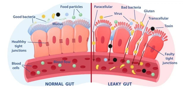 Reducing Gut Inflammation Reducing Gut Inflammation