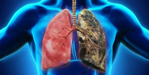 Lung disease Lung disease