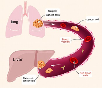 Nebijokite, jei sergate vėžiu. Tiesiog išmokite šiuos 4 metodus, kaip slopint...