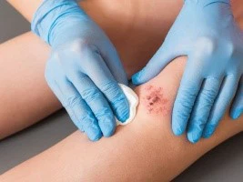 KPV Promotion of Wound Healing