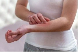 KPV Mild Irritation or Redness Topical Use